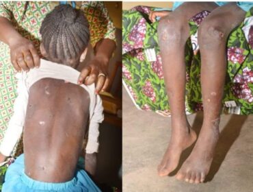 Burkina/Ouagadougou: Une fillette de 8 ans sauvée d’abus physique